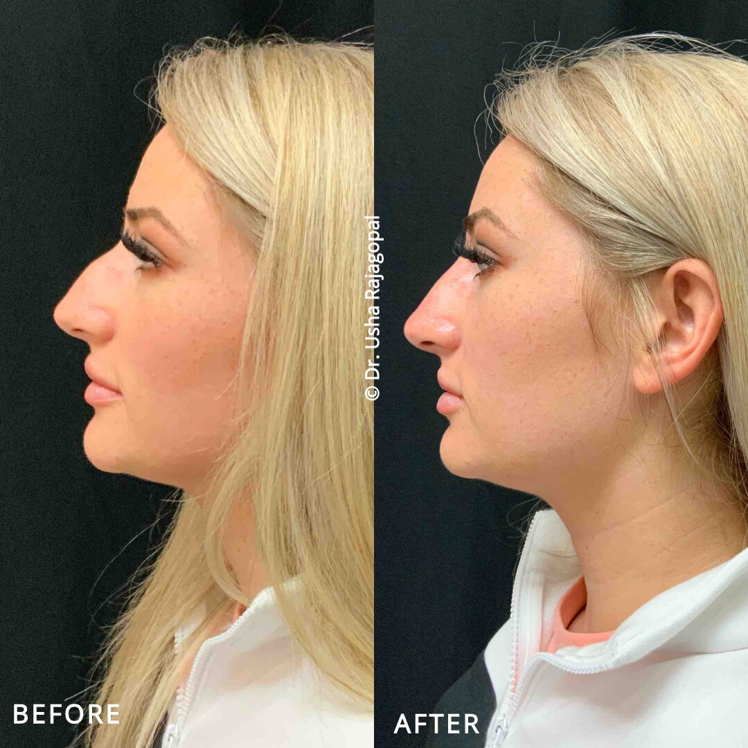 rhinoplasty expert nyc