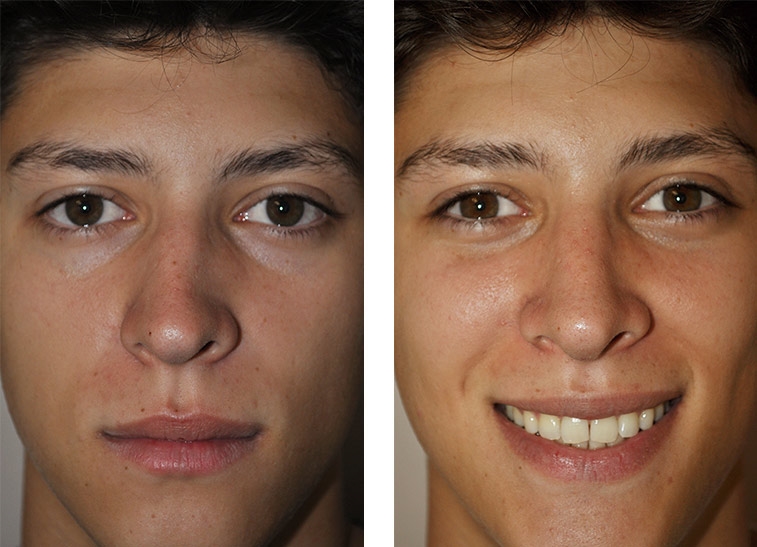 rhinoplasty expert nyc